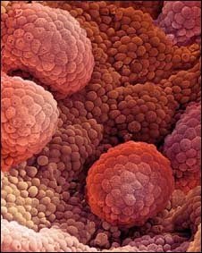 primeiros sintomas de cancer de próstata